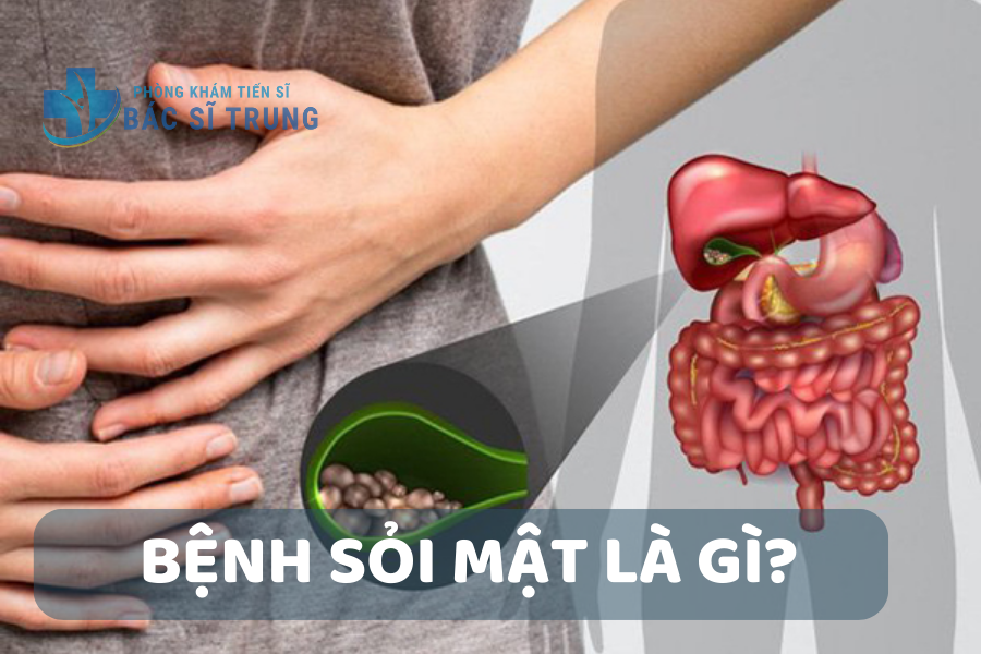 Bệnh sỏi mật là gì