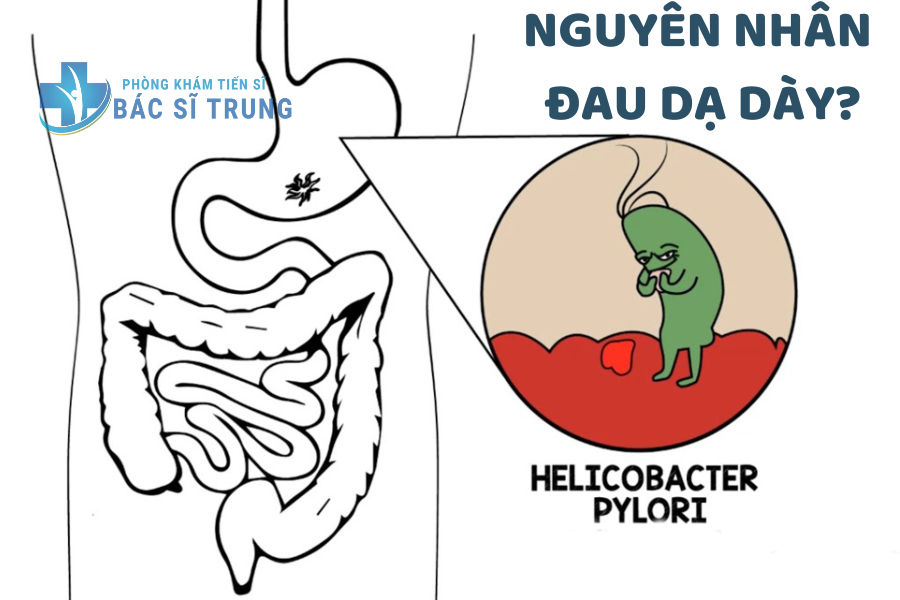Nguyên nhân gây bệnh đau dạ dày