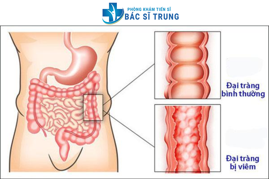 đại tràng co thắt