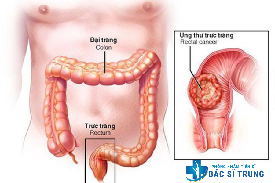bệnh đại trực tràng