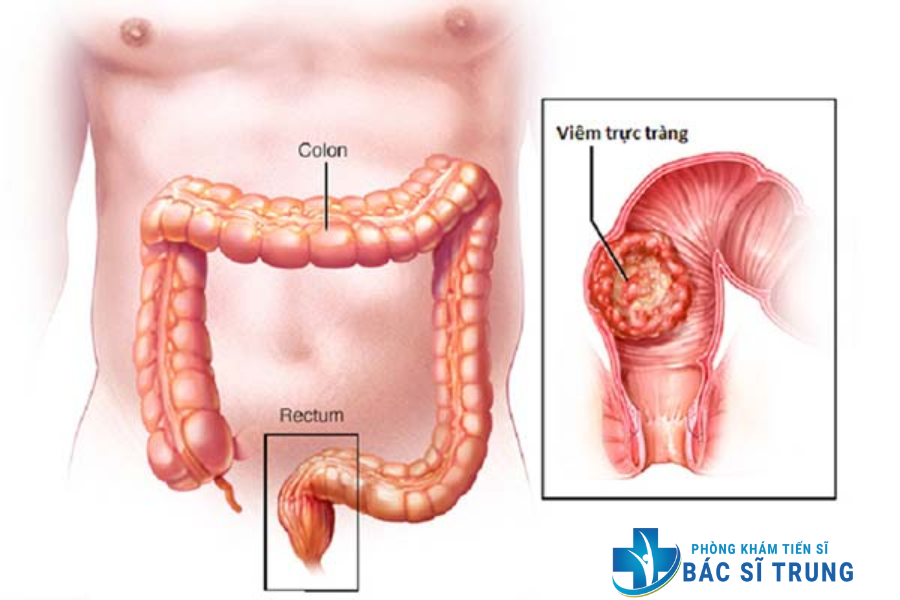 viêm trực tràng