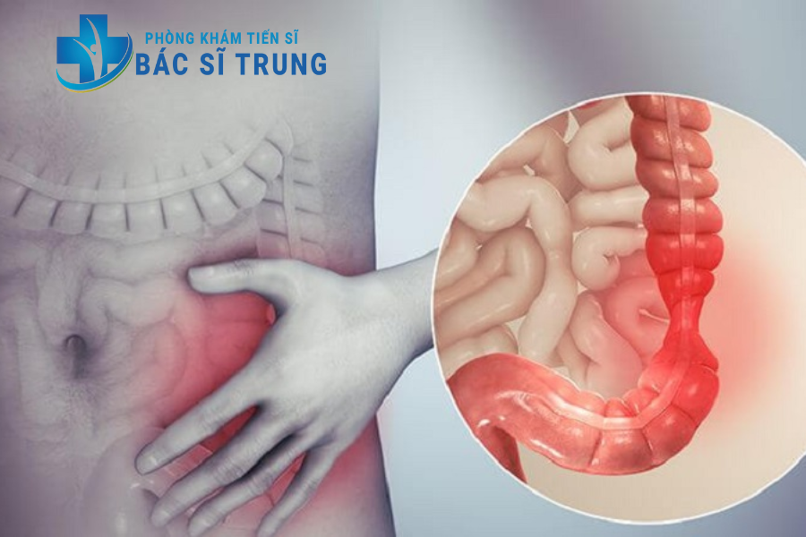đại tràng co thắt