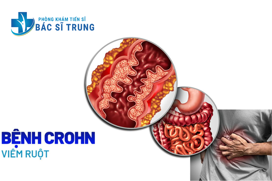 viêm trực tràng