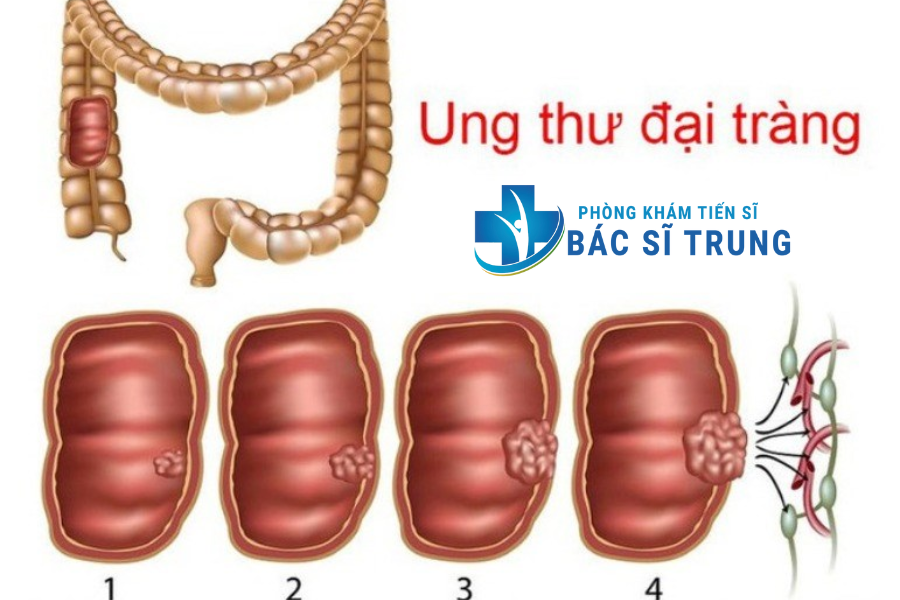 viêm trực tràng