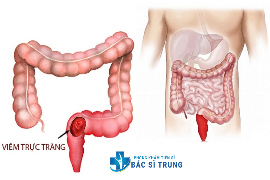 viêm trực tràng
