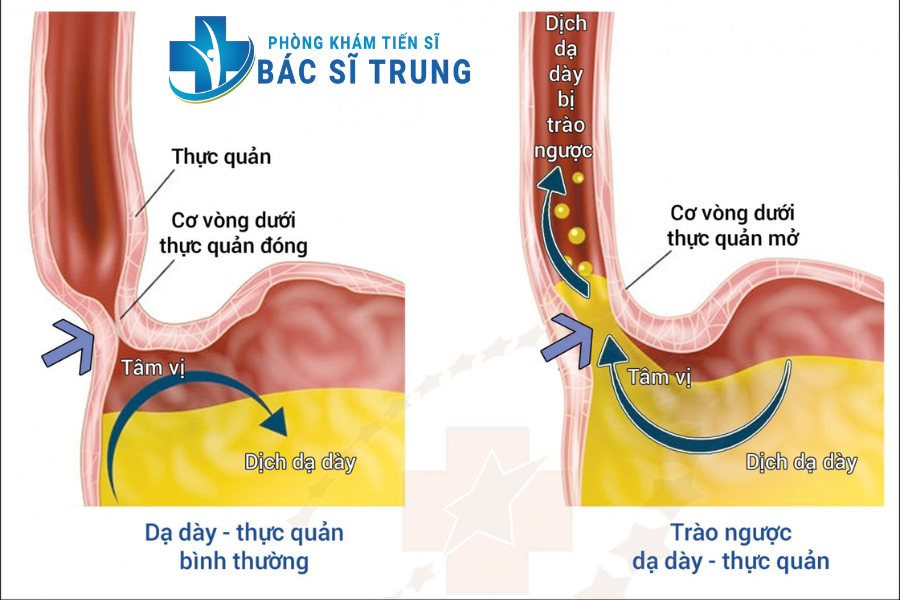bệnh trào ngược thực quản