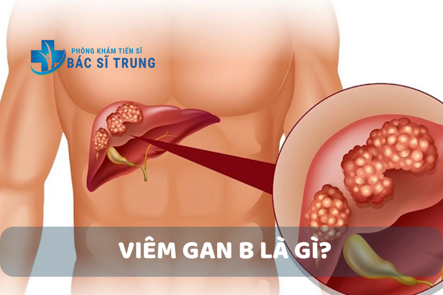 Viêm gan B là gì