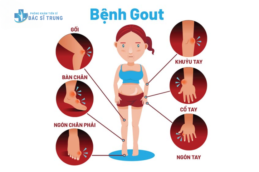 10. Những Câu Hỏi Thường Gặp Về Bệnh Gout