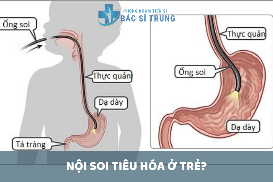 Tại sao cần nội soi tiêu hóa ở trẻ