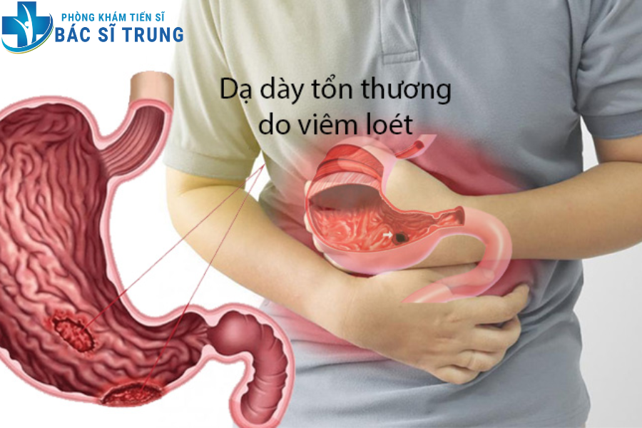 điều trị viêm loét dạ dày