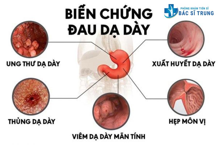 điều trị viêm loét dạ dày