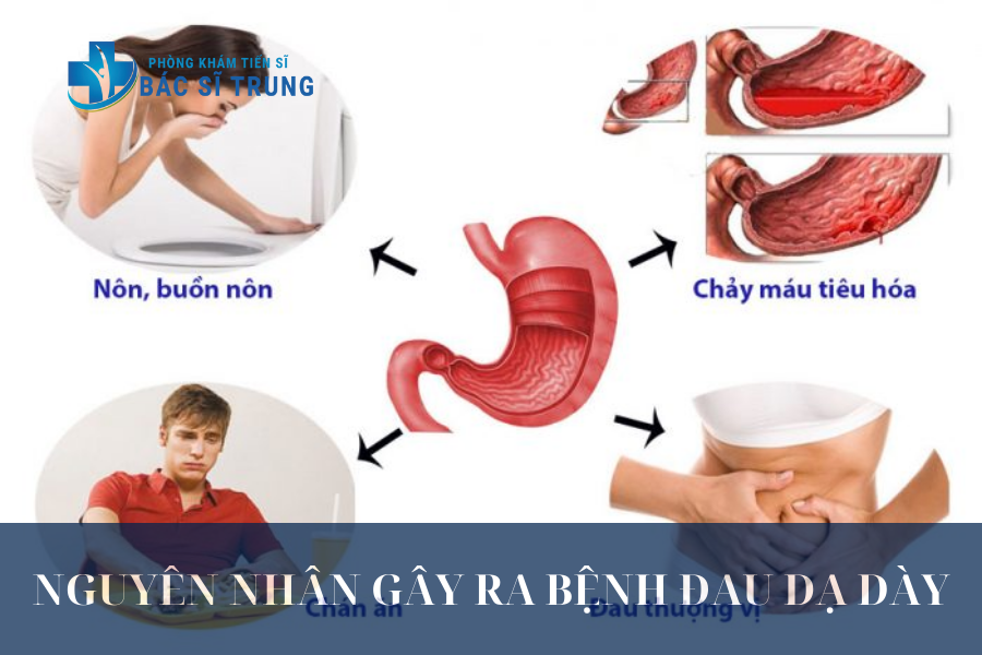 Nguyên nhân gây ra bệnh đau dạ dày